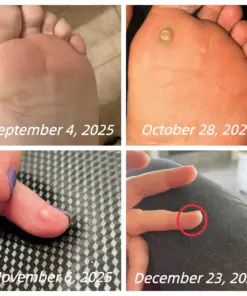 Healrize® Bee Venom Spray Joint Relief Wart Treatment, Two Effects in One Bottle