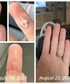 Healrize® Bee Venom Spray Joint Relief Wart Treatment, Two Effects in One Bottle