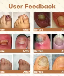 Healrize® NailRescue BeeVenom Renewal Spray