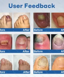 Healrize®Nano Rapid Clear Nail Fungus Rapair Liquid Effective in Seven Days, Permanently Eliminates the Root