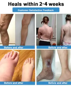 Healrize® 4-in-1 Vein & Joint Nano Microneedle Advanced Therapy Patch