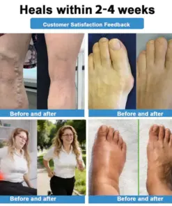 Healrize® 4-in-1 Vein & Joint Nano Microneedle Advanced Therapy Patch