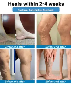 Healrize® 4-in-1 Vein & Joint Nano Microneedle Advanced Therapy Patch