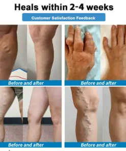 Healrize® 4-in-1 Vein & Joint Nano Microneedle Advanced Therapy Patch