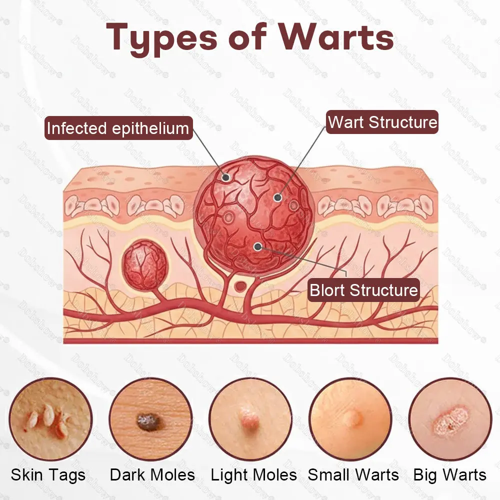 Healrize® BlackRice DermCorrect™ Wart Recovery Cream Suitable for all skin types