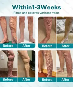 Healrize® Rapid Vein Relief Microdarts