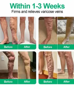 Healrize® VeinEase Microneedle Care PatchInstant Relief, Long-Term Results