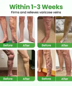 Healrize® VeinHeal Microneedle Patch