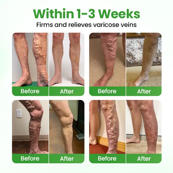 Healrize® VeinHeal Microneedle Patch