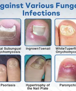 Healrize®Nano Rapid Clear Nail Fungus Rapair Liquid Effective in 7 Days, Permanently Eliminates the Root