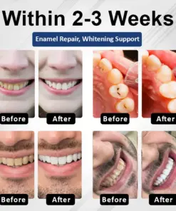 Healrize® BioEnamel Biomimetic Tooth Armor