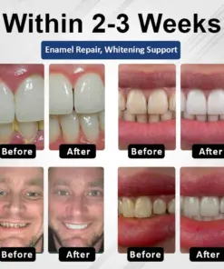 Healrize® BioEnamel Biomimetic Tooth Armor