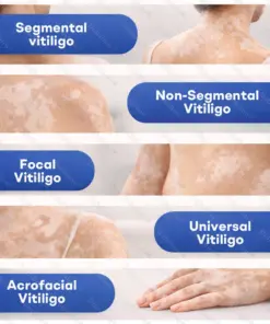 Healrize® Piperine Vitiligo Repigmentation Spray