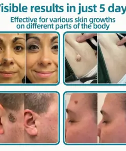 ๐๐๐๐๐ฟ๐ถ๐ฏ๐ยฎ2-in-1 Microneedle & Hydrocolloid Patch