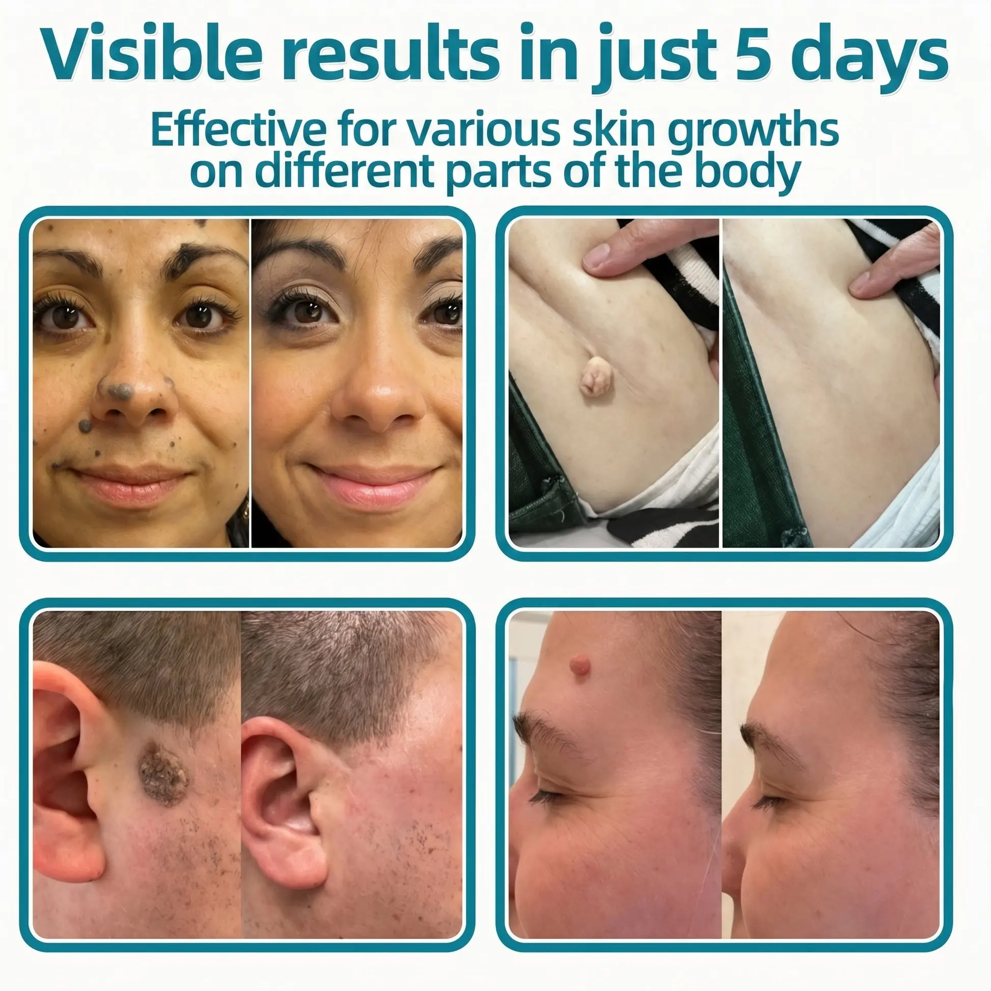 ๐๐๐๐๐ฟ๐ถ๐ฏ๐ยฎ2-in-1 Microneedle & Hydrocolloid Patch