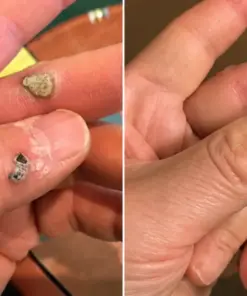 ๐๐๐๐๐ฟ๐ถ๐ฏ๐ยฎ2-in-1 Microneedle & Hydrocolloid Patch