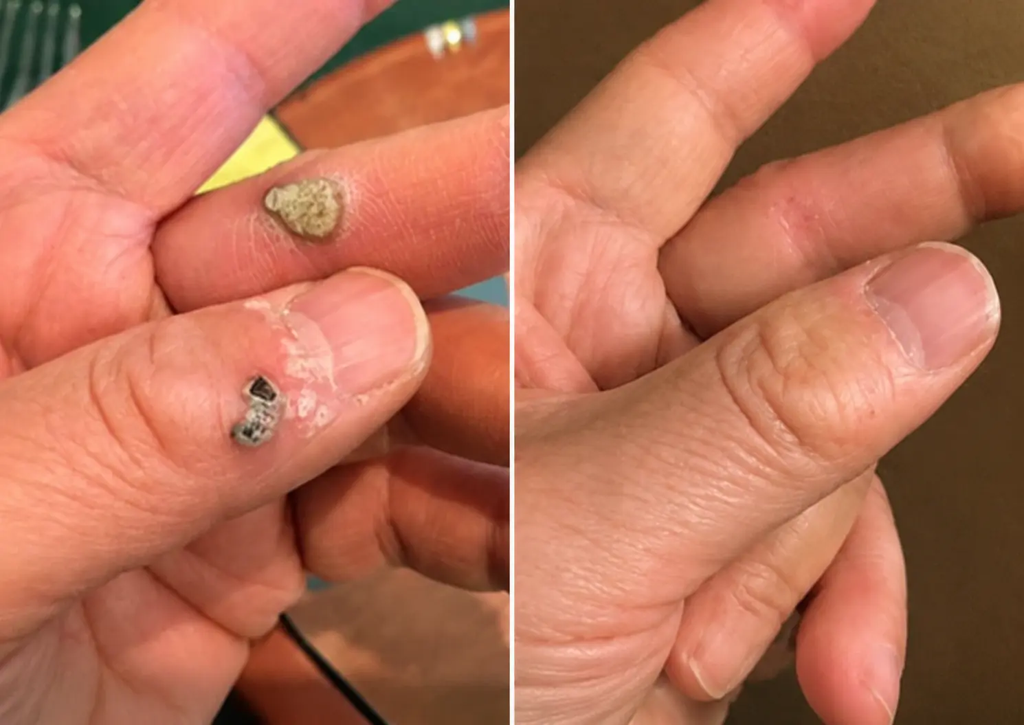 ๐๐๐๐๐ฟ๐ถ๐ฏ๐ยฎ2-in-1 Microneedle & Hydrocolloid Patch