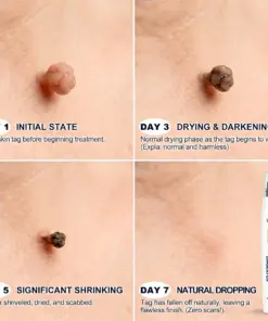 Healrize® 7-Day Skin Tag & Spot Eraser Painless & Scar-Free Advanced Imperfection Removal Rollerball Pen