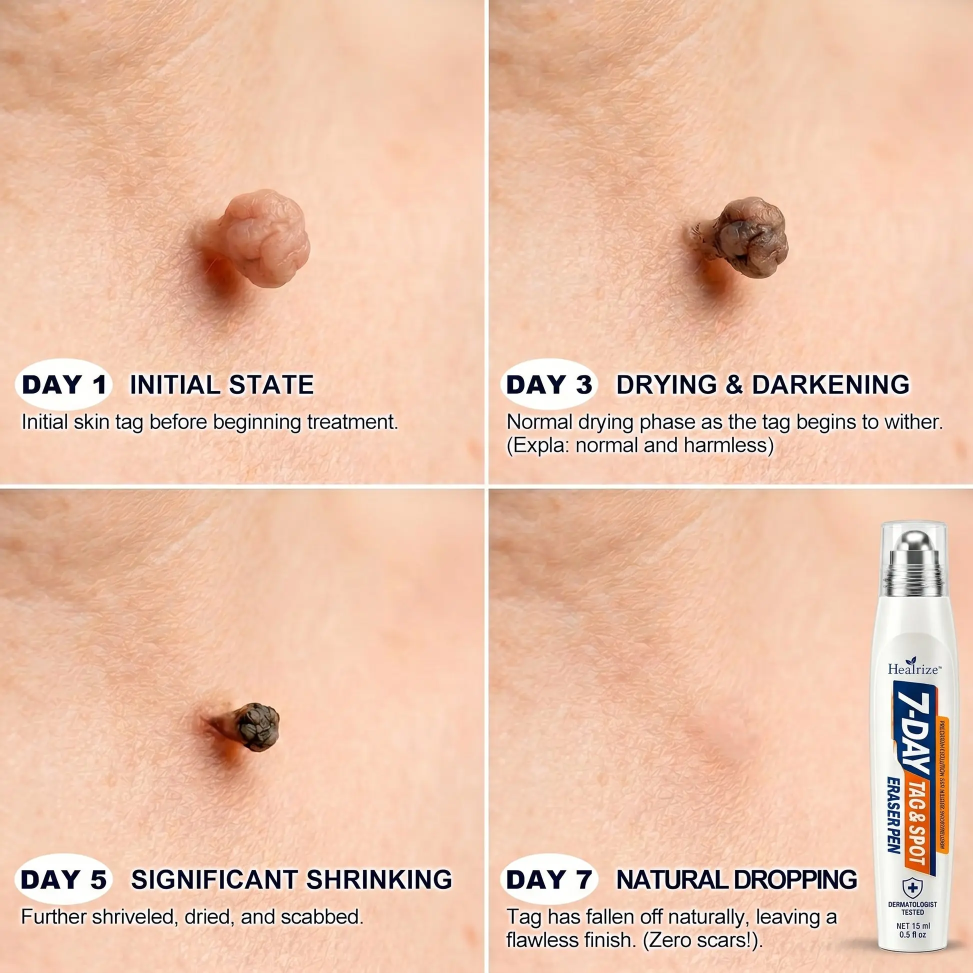 Healrize® 7-Day Skin Tag & Spot Eraser Painless & Scar-Free Advanced Imperfection Removal Rollerball Pen
