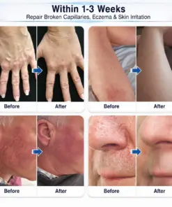 ๐ฏ๐ฒ๐๐ฅ๐๐ถ๐ฏ๐ฒยฎ 0.05 mm Premium Micro-Tip Rollers for Vein Care